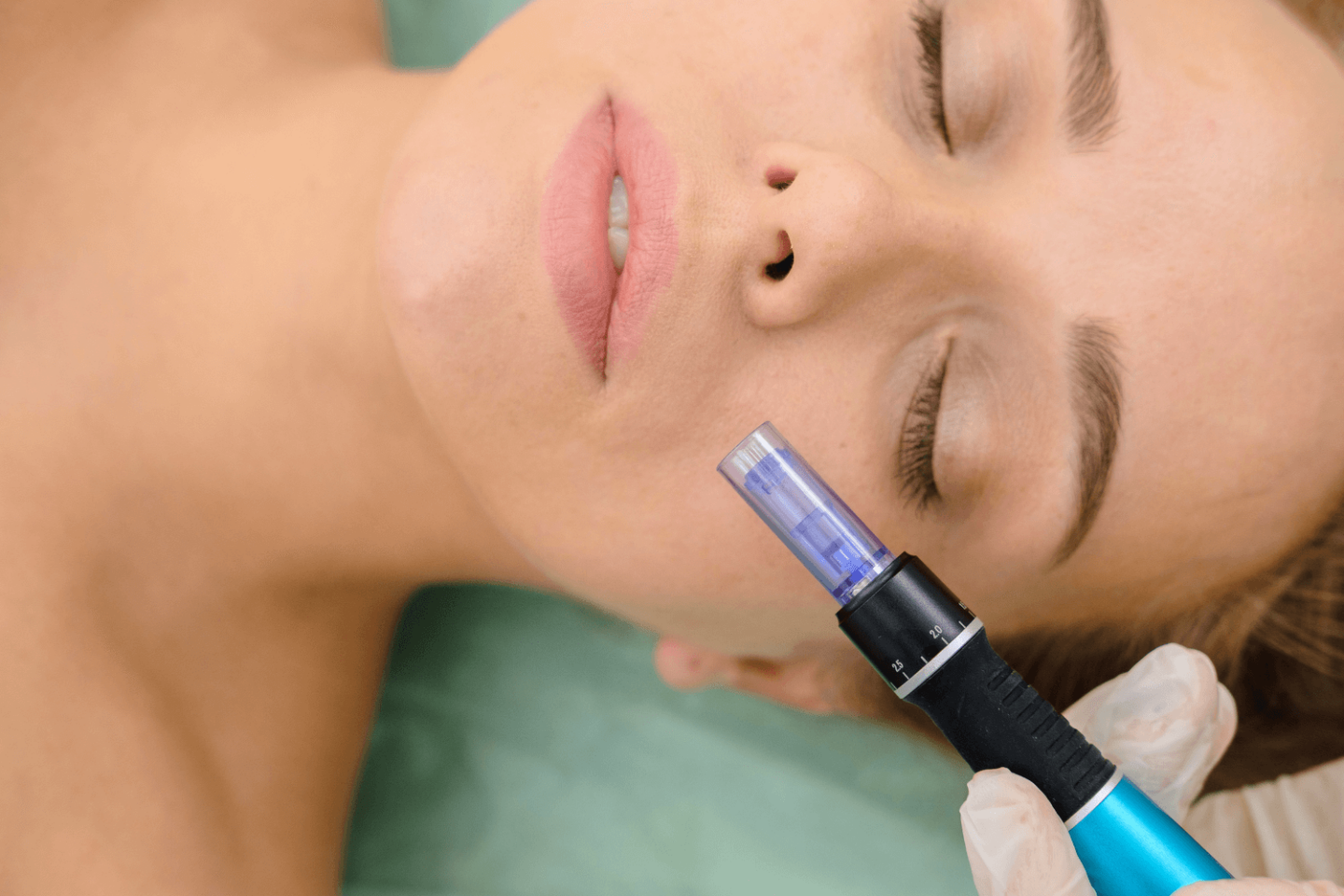 Woman receiving treatment with microneedling pens